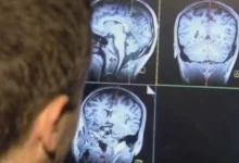 علاج مناعي يحدث اختراقاً جديداً في علاج سرطان الرقبة والرأس
